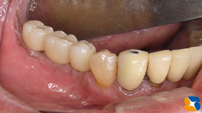 奈良　生駒　石切　インプラント　寝ながら無痛インプラント　良心価格　10年保証　再生医療