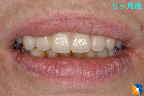 大阪　奈良市　生駒市　インプラント　静脈麻酔鎮静　寝ながら　リラックス　再生医療