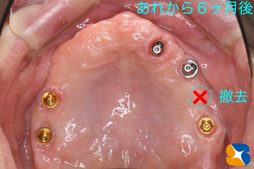 大阪　奈良市　生駒市　インプラント　静脈麻酔鎮静　リラックス　再生医療