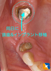 石切　生駒　奈良　大阪　インプラント　近畿厚生局認可　再生医療施設　静脈麻酔鎮静法
