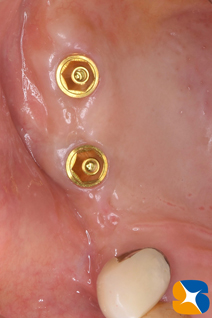 石切　奈良市　生駒市　大阪市　静脈麻酔　再生医療歯科　保険