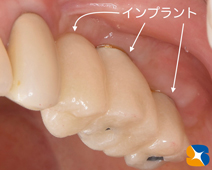 石切　奈良市　生駒市　大阪市　静脈麻酔　再生医療歯科　保険