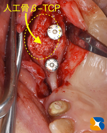 石切　生駒　奈良　大阪　インプラント　近畿厚生局認可　再生医療施設　静脈麻酔鎮静法