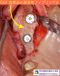 石切　生駒　奈良　大阪　インプラント　近畿厚生局認可　再生医療施設　静脈麻酔鎮静法
