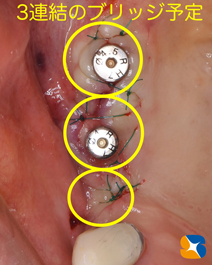 石切　生駒　奈良　大阪　インプラント　近畿厚生局認可　再生医療施設　静脈麻酔鎮静法