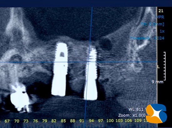 石切　生駒　奈良　大阪　インプラント　近畿厚生局認可　再生医療施設　静脈麻酔鎮静法