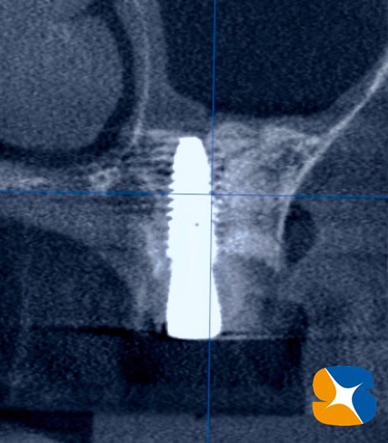 生駒　奈良　石切　大阪　再生医療　静脈麻酔鎮静　歯科インプラント