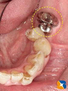 生駒　奈良　大阪　静脈麻酔付きインプラント　骨や歯茎の早期再生療法　