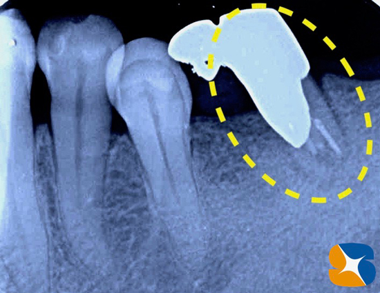 生駒　奈良　大阪　静脈麻酔付きインプラント　骨や歯茎の早期再生療法　