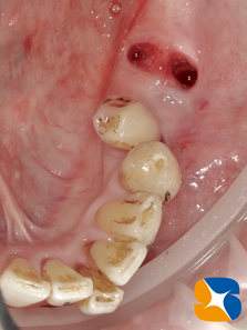 生駒　奈良　大阪　静脈麻酔付きインプラント　骨や歯茎の早期再生療法　
