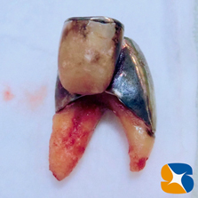 生駒　奈良　大阪　静脈麻酔付きインプラント　骨や歯茎の早期再生療法　