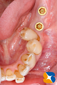 生駒　奈良　大阪　静脈麻酔付きインプラント　骨や歯茎の早期再生療法　