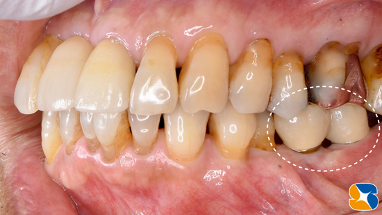 生駒　奈良　大阪　静脈麻酔付きインプラント　骨や歯茎の早期再生療法　