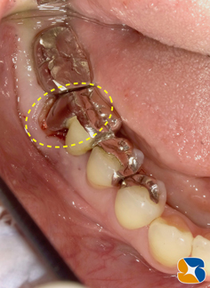プロフェッショナル　鈴木　ブリッジ　インプラント　静脈麻酔鎮静付き手術　フィブリン再生医療　奈良　生駒　大阪