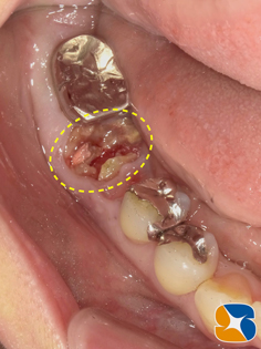プロフェッショナル　鈴木　ブリッジ　インプラント　静脈麻酔鎮静付き手術　フィブリン再生医療　奈良　生駒　大阪