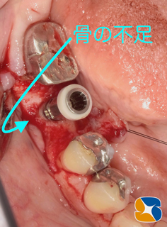 プロフェッショナル　鈴木　ブリッジ　インプラント　静脈麻酔鎮静付き手術　フィブリン再生医療　奈良　生駒　大阪