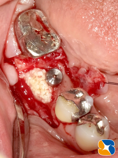 プロフェッショナル　鈴木　ブリッジ　インプラント　静脈麻酔鎮静付き手術　フィブリン再生医療　奈良　生駒　大阪