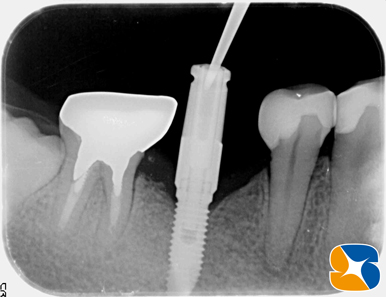 プロフェッショナル　鈴木　ブリッジ　インプラント　静脈麻酔鎮静付き手術　フィブリン再生医療　奈良　生駒　大阪