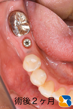 プロフェッショナル　鈴木　ブリッジ　インプラント　静脈麻酔鎮静付き手術　フィブリン再生医療　奈良　生駒　大阪