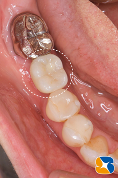 プロフェッショナル　鈴木　ブリッジ　インプラント　静脈麻酔鎮静付き手術　フィブリン再生医療　奈良　生駒　大阪