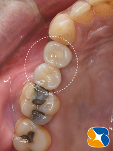プロフェッショナル　鈴木歯科　ブリッジ　インプラント　静脈麻酔鎮静付き手術　フィブリン再生医療　奈良　生駒　大阪