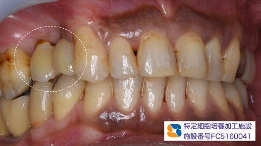 プロフェッショナル　鈴木歯科　ブリッジ　インプラント　静脈麻酔鎮静付き手術　フィブリン再生医療　奈良　生駒　大阪