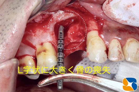 プロフェッショナル　鈴木歯科　ブリッジ　インプラント　静脈麻酔鎮静付き手術　フィブリン再生医療　奈良　生駒　大阪