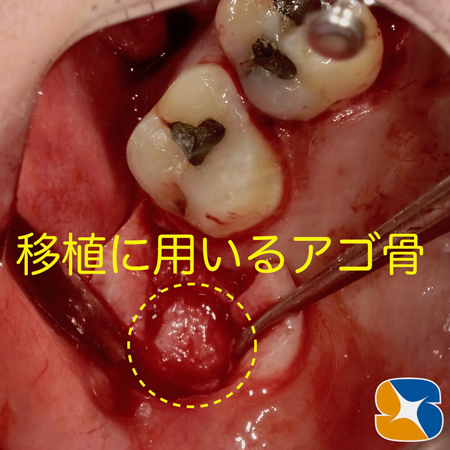 プロフェッショナル　鈴木歯科　ブリッジ　インプラント　静脈麻酔鎮静付き手術　フィブリン再生医療　奈良　生駒　大阪