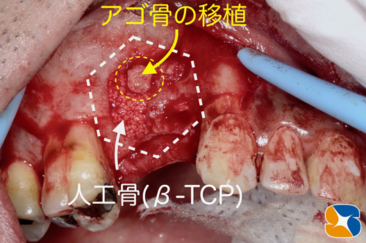 プロフェッショナル　鈴木歯科　ブリッジ　インプラント　静脈麻酔鎮静付き手術　フィブリン再生医療　奈良　生駒　大阪