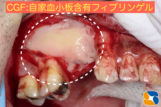 プロフェッショナル　鈴木歯科　ブリッジ　インプラント　静脈麻酔鎮静付き手術　フィブリン再生医療　奈良　生駒　大阪