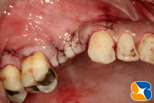プロフェッショナル　鈴木歯科　ブリッジ　インプラント　静脈麻酔鎮静付き手術　フィブリン再生医療　奈良　生駒　大阪
