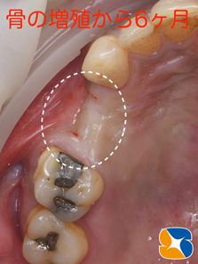 プロフェッショナル　鈴木歯科　ブリッジ　インプラント　静脈麻酔鎮静付き手術　フィブリン再生医療　奈良　生駒　大阪