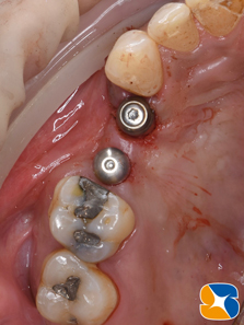 プロフェッショナル　鈴木歯科　ブリッジ　インプラント　静脈麻酔鎮静付き手術　フィブリン再生医療　奈良　生駒　大阪