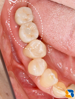 奈良　生駒　王寺　郡山　石切　東大阪　インプラント　寝ながら低価格静脈麻酔鎮静　最新再生医療