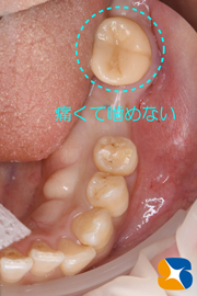奈良　生駒　最新再生医療インプラント　石切　大阪　静脈麻酔鎮静無料