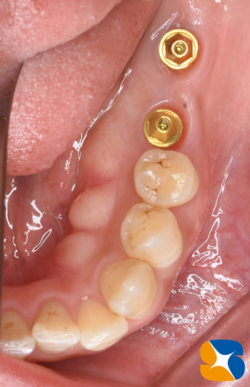 奈良　生駒　最新再生医療インプラント　石切　大阪　静脈麻酔鎮静無料