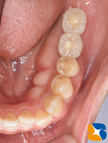 奈良　生駒　最新再生医療インプラント　石切　大阪　静脈麻酔鎮静無料