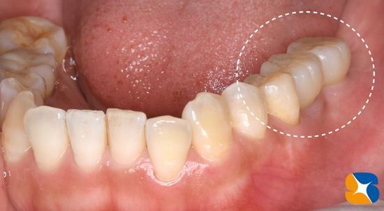 奈良　生駒　最新再生医療インプラント　石切　大阪　静脈麻酔鎮静無料