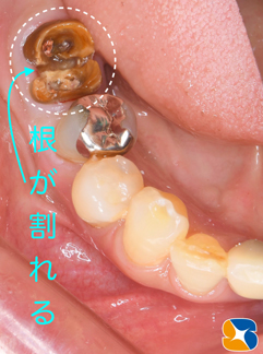 奈良　生駒　王寺　郡山　石切　東大阪　インプラント　寝ながら低価格静脈麻酔鎮静　最新再生医療