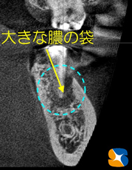 奈良　生駒　最新再生医療インプラント　石切　大阪　静脈麻酔鎮静無料