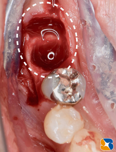 奈良　生駒　王寺　郡山　石切　東大阪　インプラント　寝ながら低価格静脈麻酔鎮静　最新再生医療