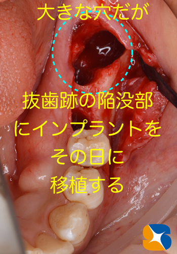 奈良　生駒　最新再生医療インプラント　石切　大阪　静脈麻酔鎮静無料