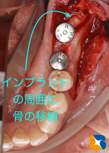 奈良　生駒　最新再生医療インプラント　石切　大阪　静脈麻酔鎮静無料