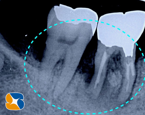 奈良　生駒　王寺　郡山　石切　東大阪　インプラント　寝ながら低価格静脈麻酔鎮静　最新再生医療