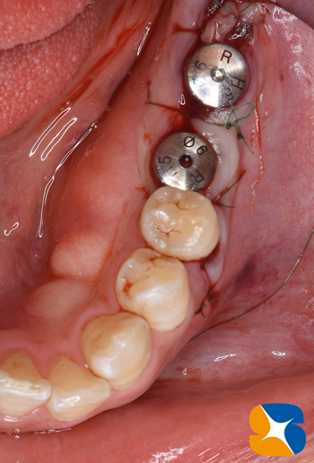 奈良　生駒　最新再生医療インプラント　石切　大阪　静脈麻酔鎮静無料