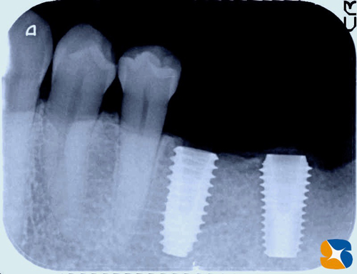 奈良　生駒　最新再生医療インプラント　石切　大阪　静脈麻酔鎮静無料