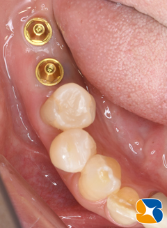 奈良　生駒　王寺　郡山　石切　東大阪　インプラント　寝ながら低価格静脈麻酔鎮静　最新再生医療