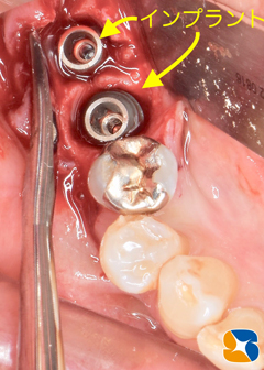 奈良　生駒　王寺　郡山　石切　東大阪　インプラント　寝ながら低価格静脈麻酔鎮静　最新再生医療
