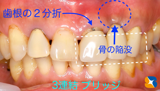 奈良　生駒　最新再生医療インプラント　石切　大阪　静脈麻酔鎮静無料