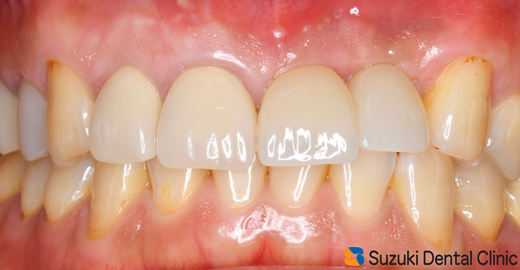 奈良　生駒　最新再生医療インプラント　石切　大阪　静脈麻酔鎮静無料